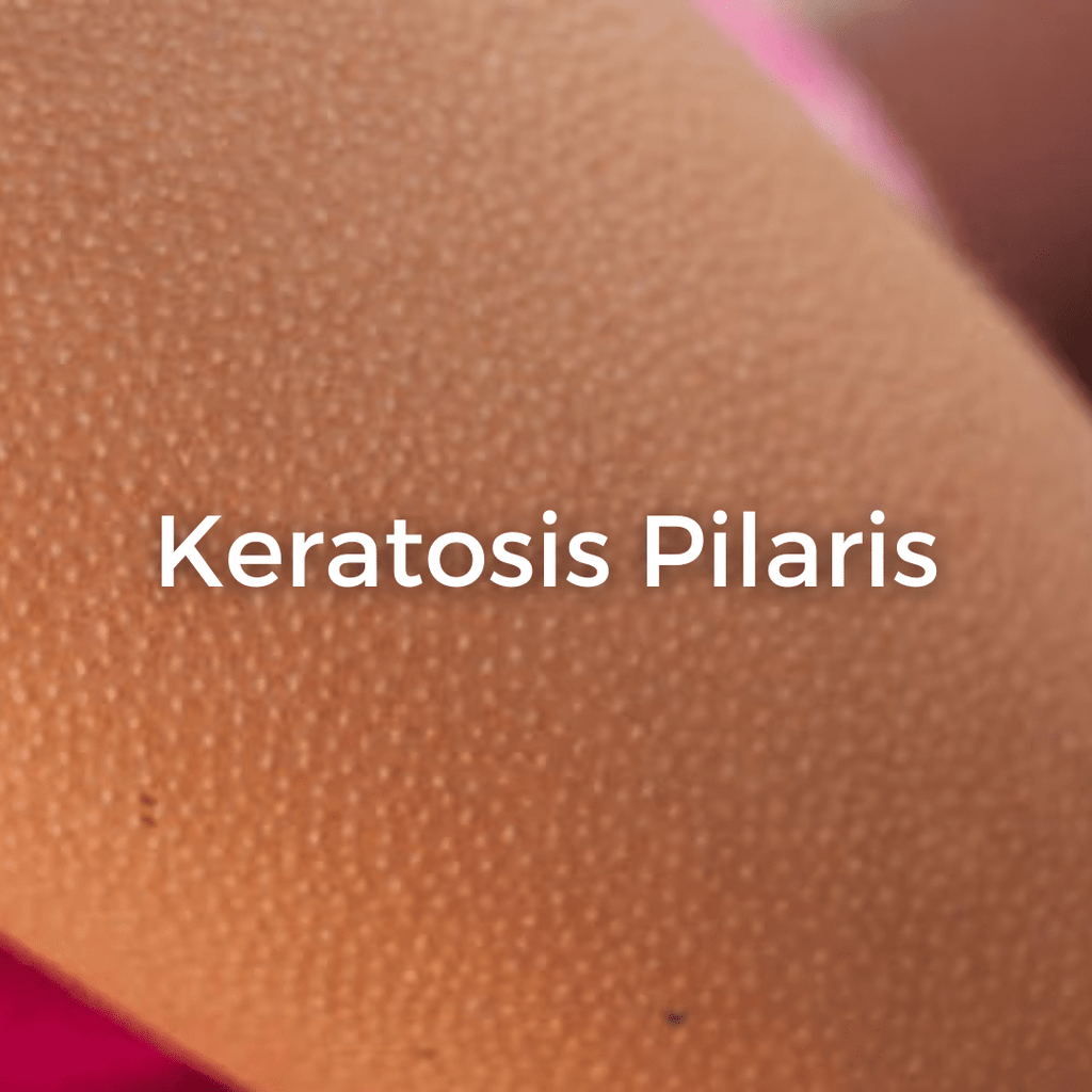 How to get rid of Keratosis Pilaris (KP), "Chicken Skin" or "Strawberry Legs" - CHEEKYGLO