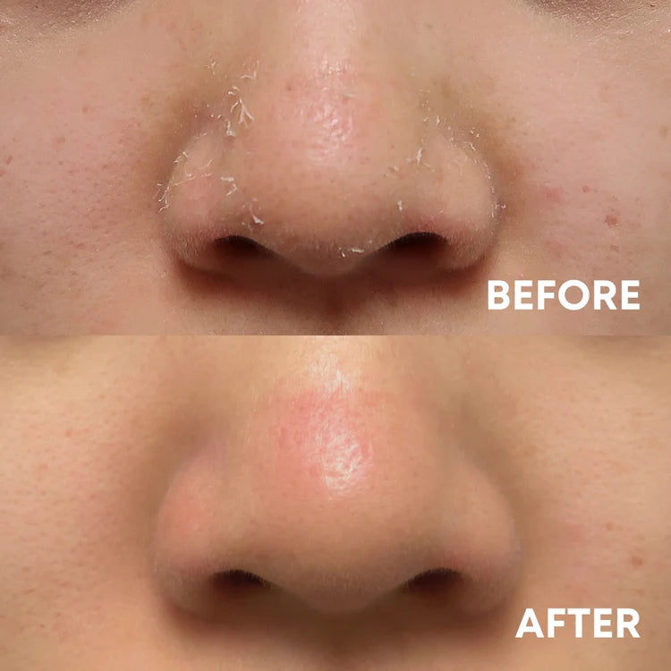 before and after using the cheekyglo silk exfoliating face mitt on flaky skin