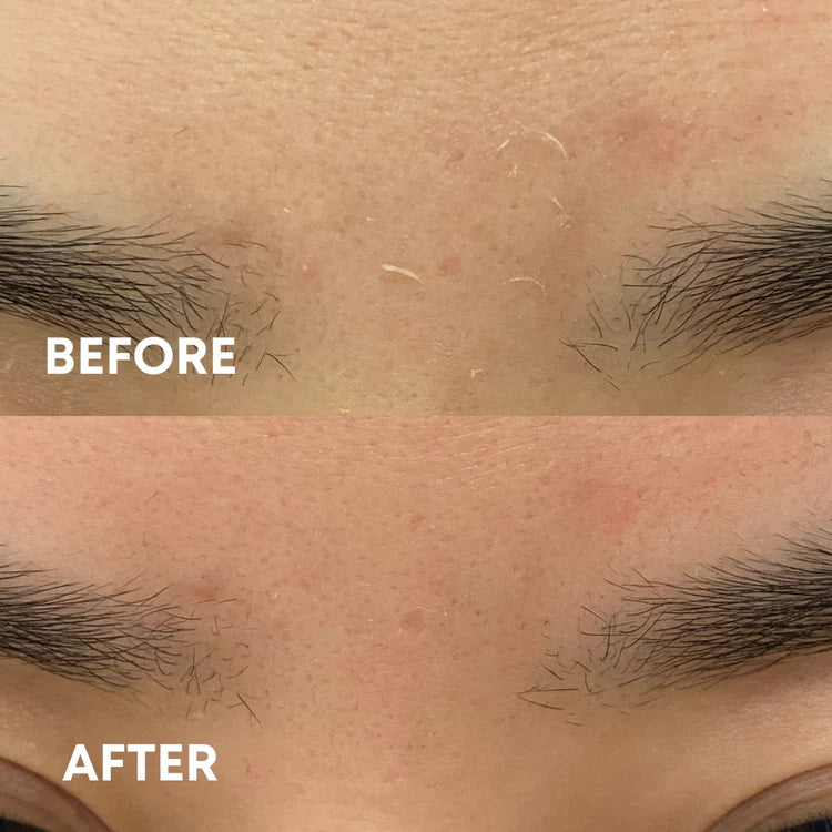 before and after results of using the cheekyglo silk exfoliating face mitt to remove dead skin on face