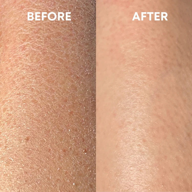 before and after using the cheekyglo exfoliating glove on scaly dry skin