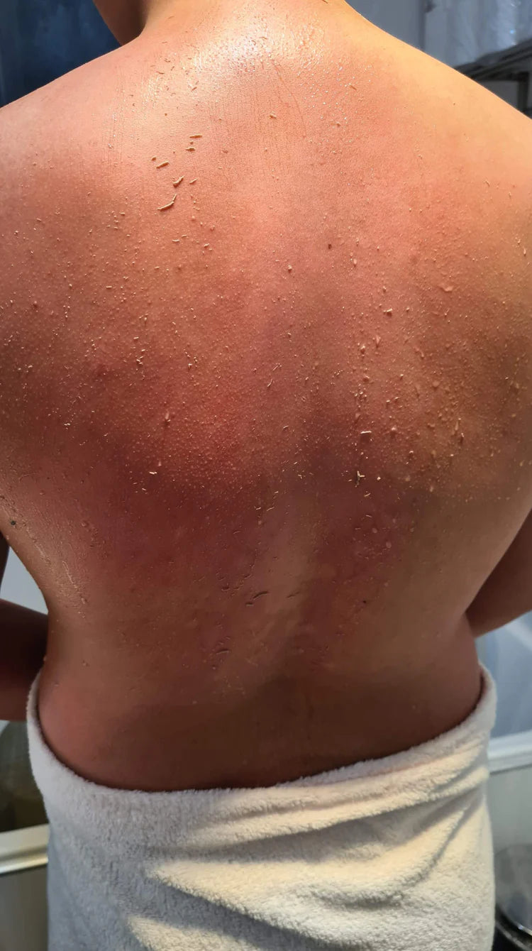 visible dead skin after using the cheekyglo exfoliating back scrubber