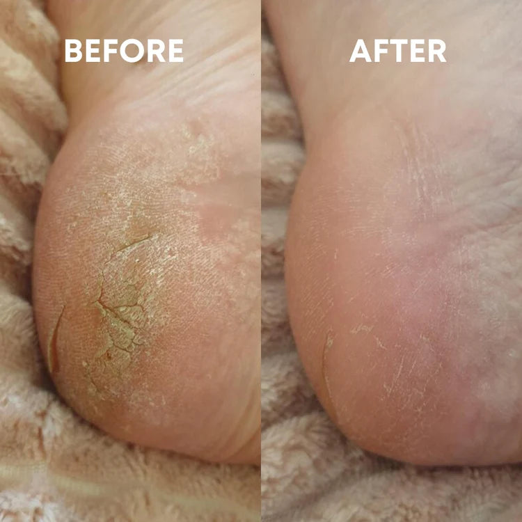 before and after result of using the cheekyglo glass foot file cracked heels
