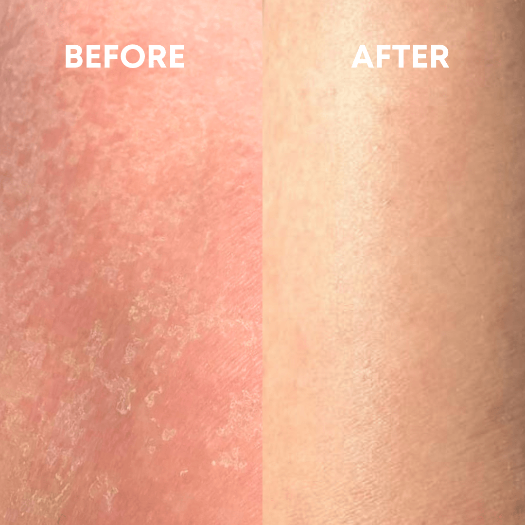 A side-by-side comparison of skin showing significant improvement. The image on the left (labeled "BEFORE") displays dry, flaky skin, while the image on the right (labeled "AFTER") shows smooth, clear skin, thanks to the CheekyGlo Sensitive Exfoliating Glove by CheekyGlo.
