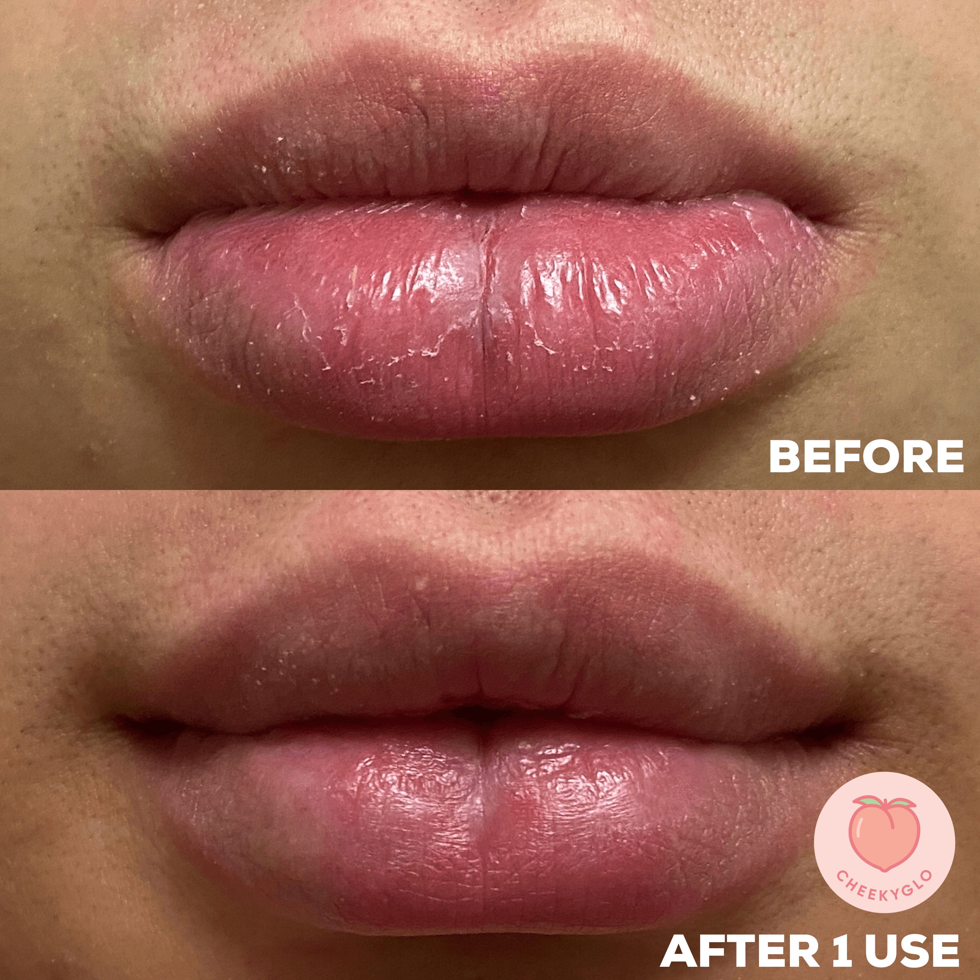 Close-up of lips in "before" and "after" shots. The "before" image shows dry, chapped lips, while the "after" image reveals smoother, more hydrated lips after using the CheekyGlo Silk Exfoliating Face Mitt by CheekyGlo. The images are labeled "BEFORE" at the top and "AFTER 1 USE" at the bottom, with a cheekyglo.