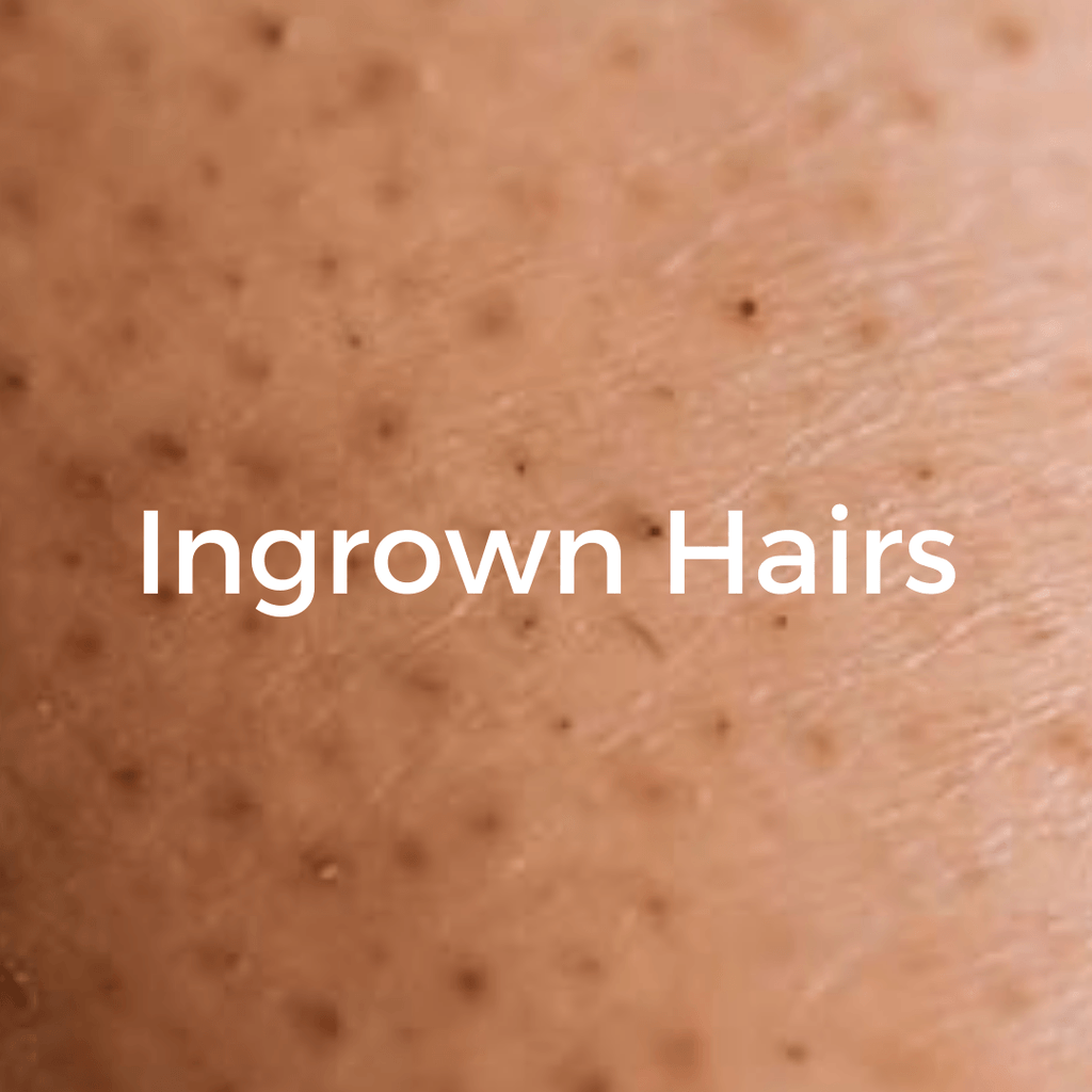 How To Get Rid Of Ingrown Hairs | Tips To Remove And Prevent Them! - CHEEKYGLO