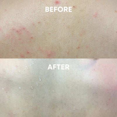 before and after using the cheekyglo back scrubber to reduce body acne or back acne