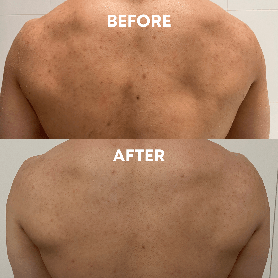 Back acne comparison