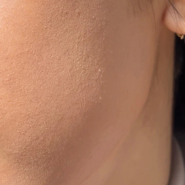 results after using the cheekyglo dermablade to remove peach fuzz and facial hair on face