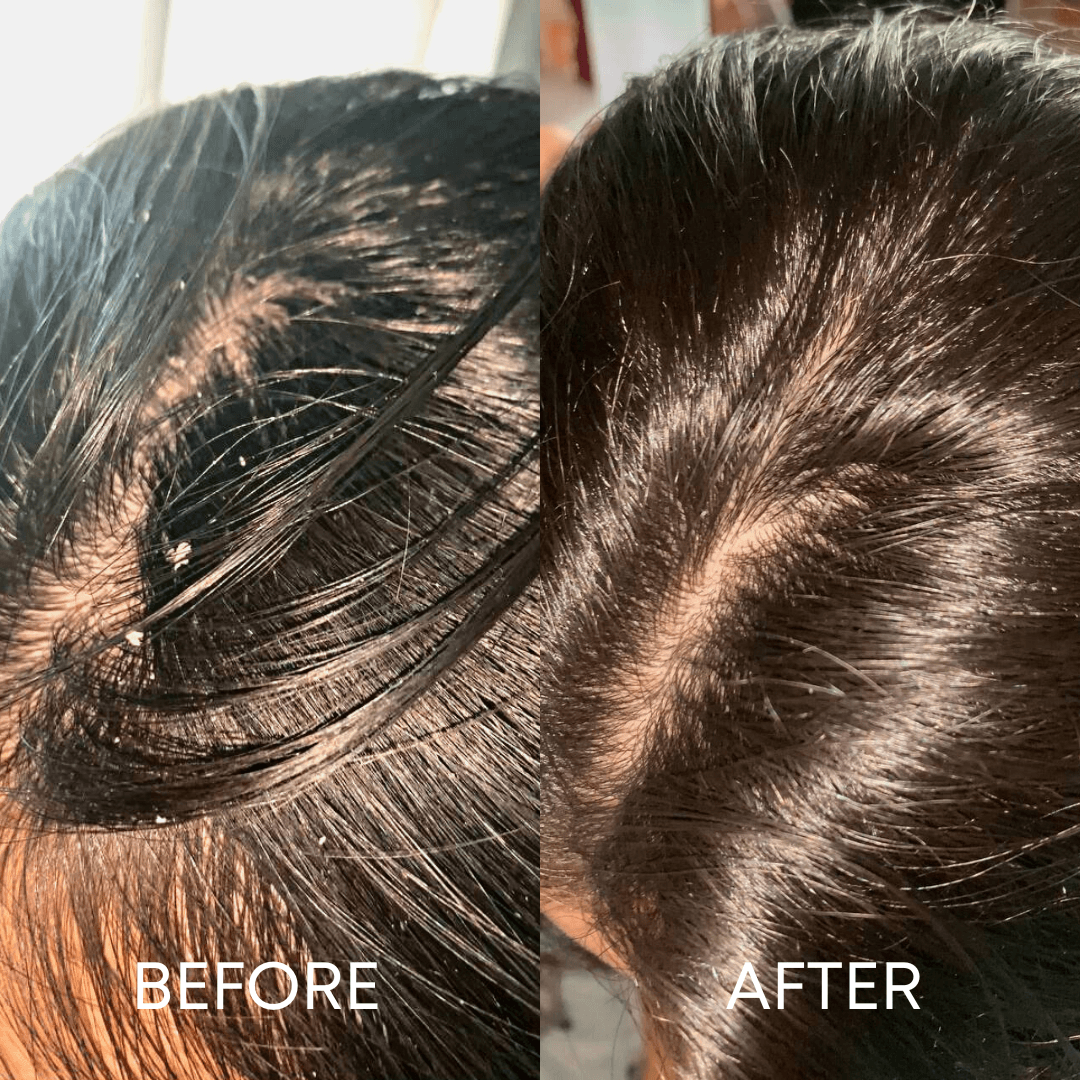 Split image showing &quot;BEFORE&quot; on the left and &quot;AFTER&quot; on the right. The &quot;BEFORE&quot; image depicts a scalp with dandruff, while the &quot;AFTER&quot; image shows a clean, dandruff-free scalp. The comparison highlights the effectiveness of CheekyGlo&