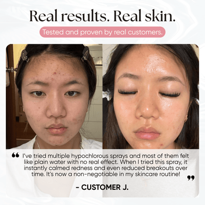 Skin Reset Hypochlorous Spray - CHEEKYGLO