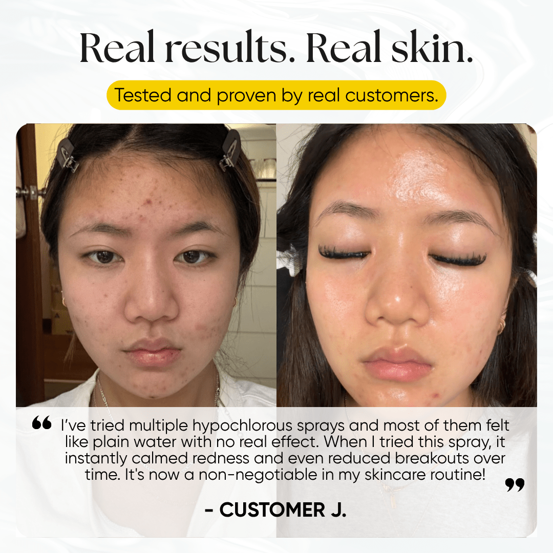 Skin Reset Hypochlorous Spray - CHEEKYGLO