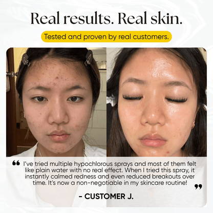 Skin Reset Hypochlorous Spray - CHEEKYGLO