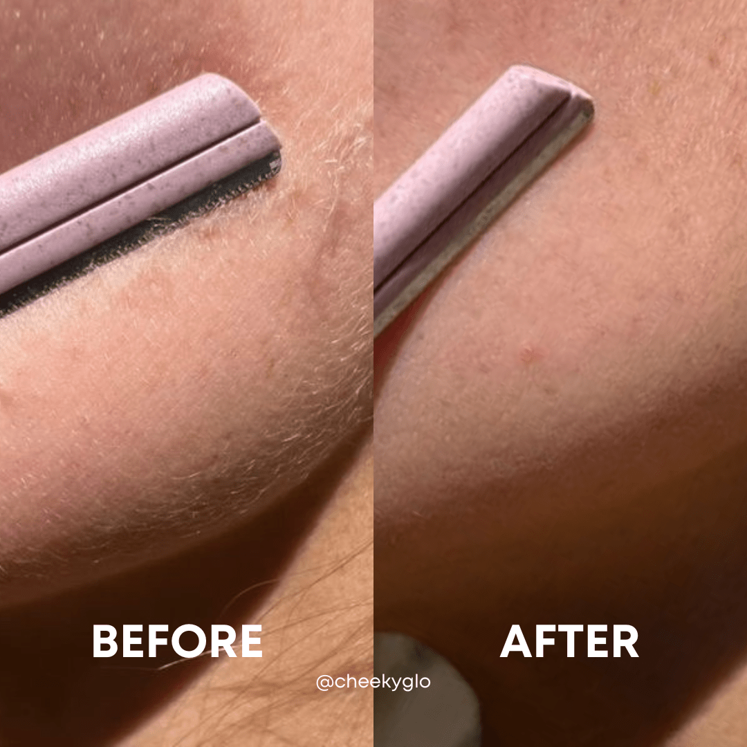 Close-up of a cheek being shaved with CheekyGlo Dermablades, a pink razor featuring eco-friendly blades. The left side shows the &quot;Before&quot; state with small hairs visible, while the right side displays the &quot;After&quot; state where CheekyGlo Dermablades have left the skin smooth and hair-free. The text &quot;BEFORE&quot; and &quot;AFTER&quot; is displayed at the bottom.