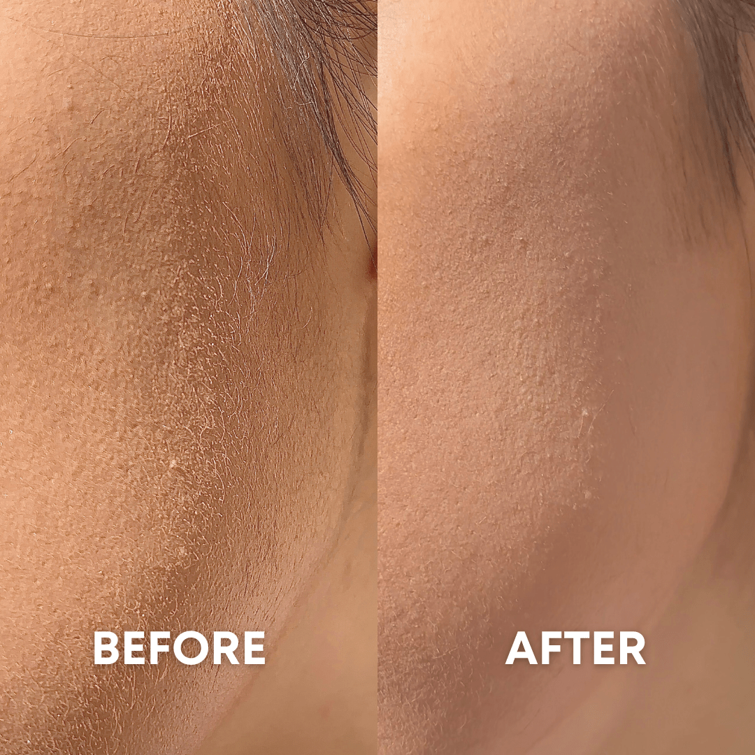 Close-up of part of a face shown in two side-by-side sections. The left side labeled &quot;Before&quot; depicts dry skin with visible flakes. The right side labeled &quot;After&quot; shows smoother, more even, and hydrated skin, thanks to CheekyGlo Dermablades by CheekyGlo.