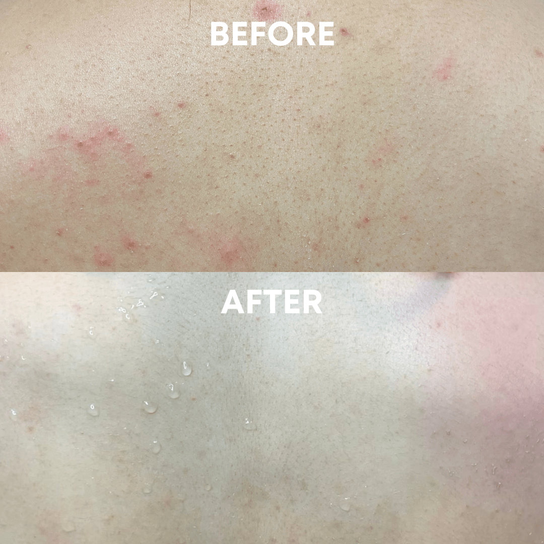 Comparison of skin condition: The top section labeled &quot;Before&quot; shows red, inflamed bumps on congested skin. The bottom section labeled &quot;After&quot; reveals clearer skin with droplets of water, indicating improvement, possibly achieved using the CheekyGlo Exfoliating Back Scrubber by CheekyGlo for effective cleansing.