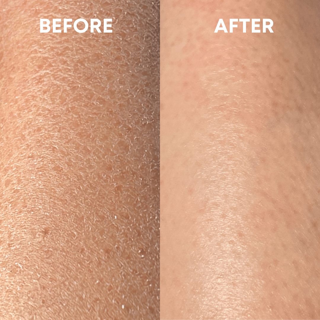 Side-by-side comparison of skin showing results before and after treatment with the CheekyGlo Exfoliating Glove. The left side labeled &quot;BEFORE&quot; displays dry, flaky skin, while the right side labeled &quot;AFTER&quot; showcases smoother, hydrated skin treated by CheekyGlo.