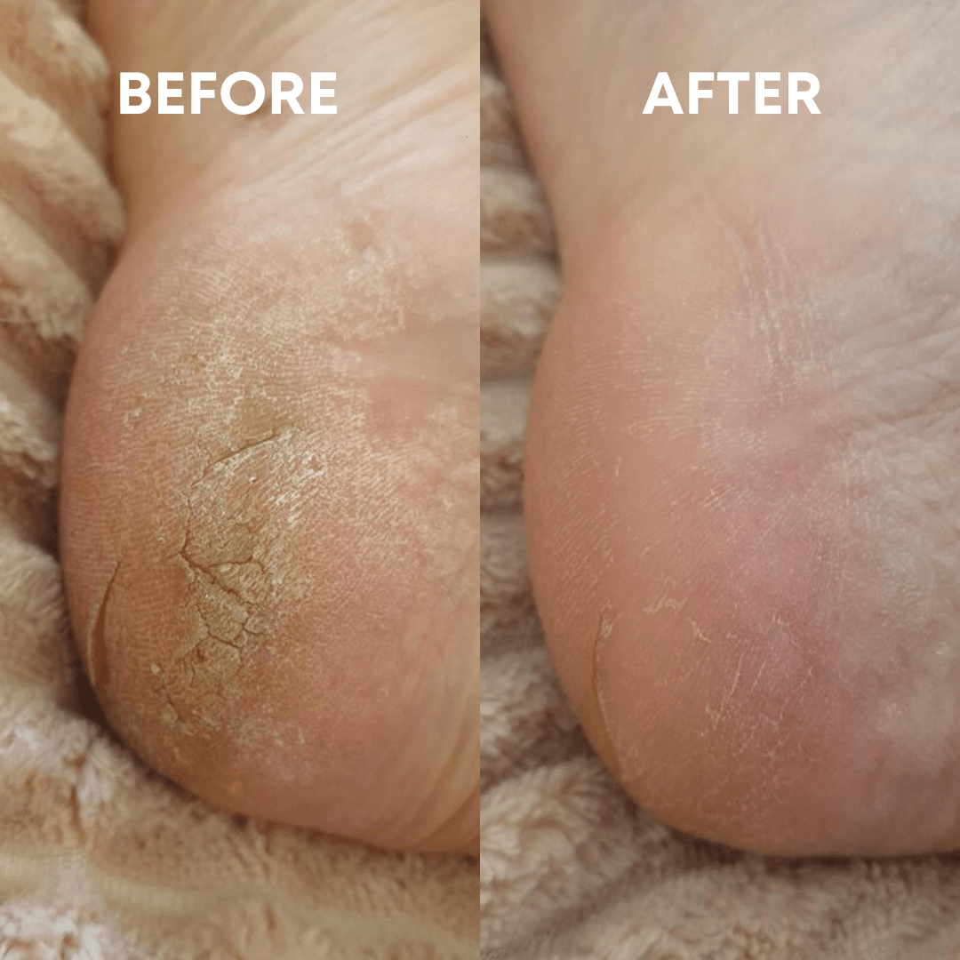 Compare the images of a heel before and after using CheekyGlo&