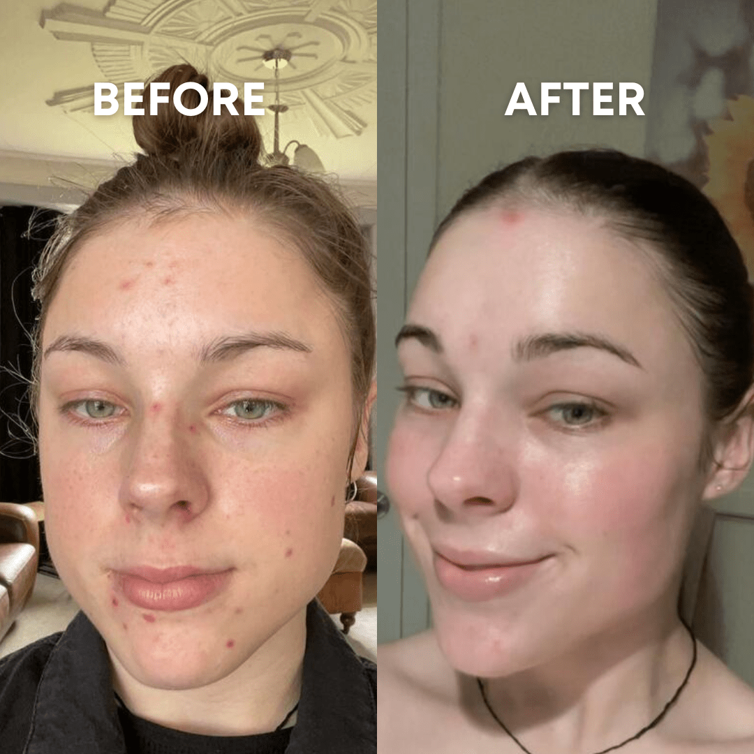 Side-by-side photos of a woman showing &quot;Before&quot; and &quot;After&quot; results of acne treatment. The &quot;Before&quot; photo shows her with significant acne and redness. The &quot;After&quot; photo, achieved using the CheekyGlo Silk Exfoliating Face Mitt by CheekyGlo, reveals clear, smoother skin with significantly less redness and acne.