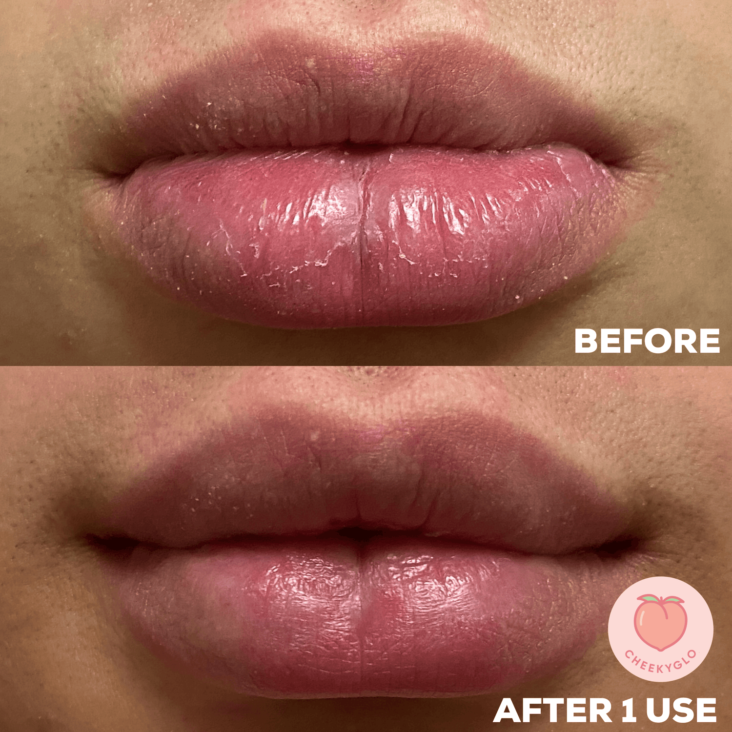 Close-up of lips in &quot;before&quot; and &quot;after&quot; shots. The &quot;before&quot; image shows dry, chapped lips, while the &quot;after&quot; image reveals smoother, more hydrated lips after using the CheekyGlo Silk Exfoliating Face Mitt by CheekyGlo. The images are labeled &quot;BEFORE&quot; at the top and &quot;AFTER 1 USE&quot; at the bottom, with a cheekyglo.